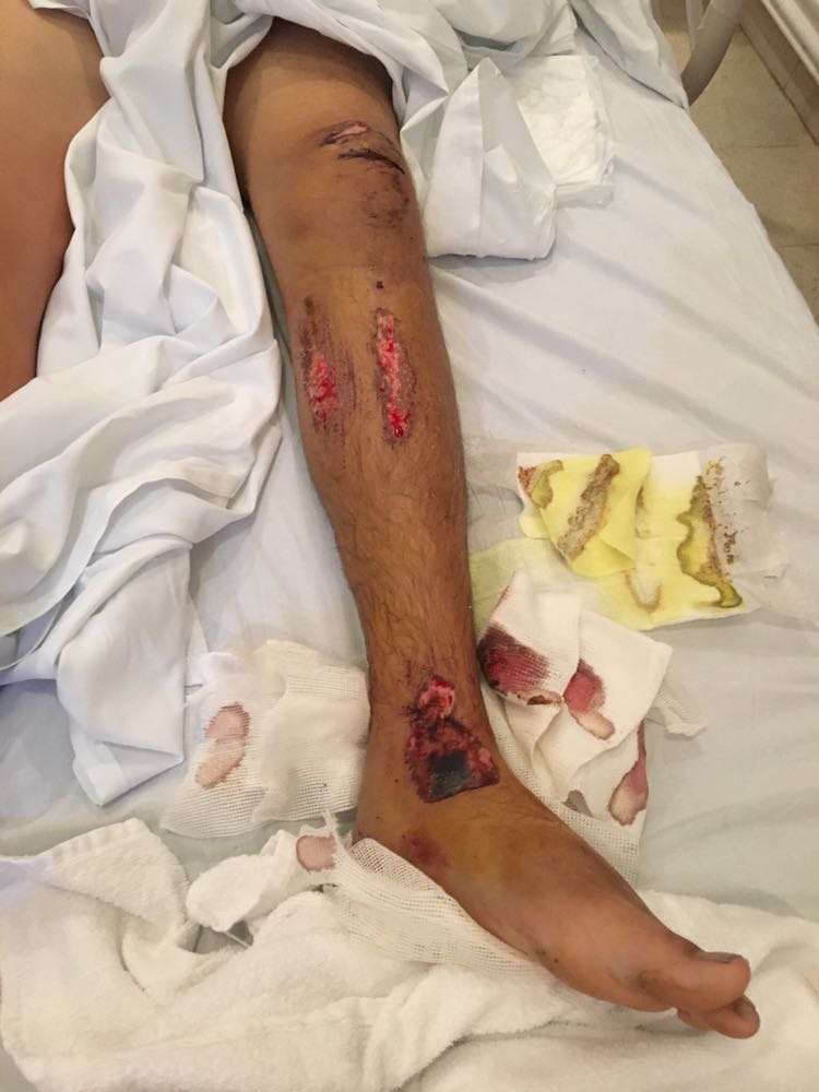 Student hit by bus Bloody Leg NEWS. JPG